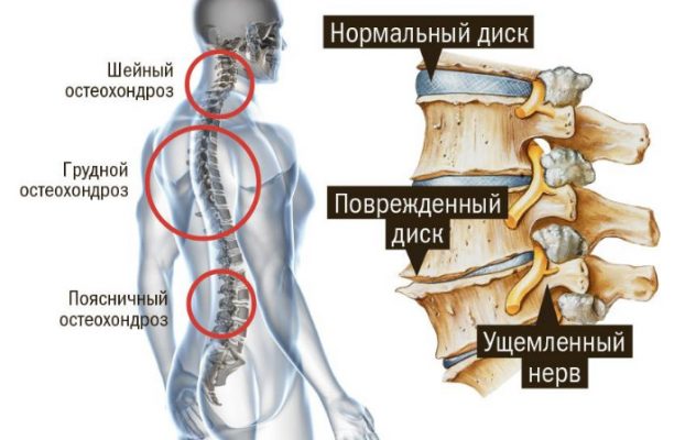 Что такое хондропротекторы?